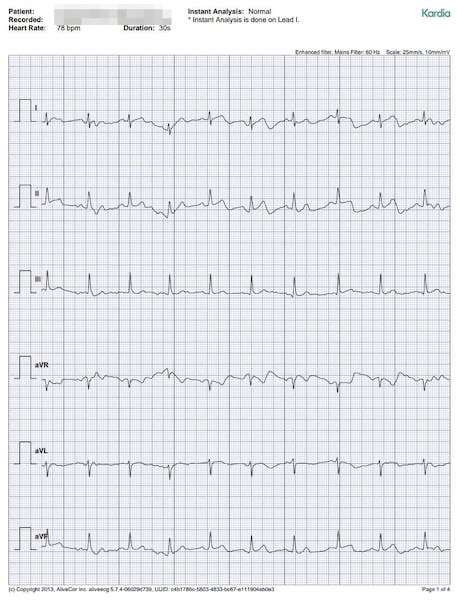 KardiaMobile 6L Personal EKG with Carry Pod